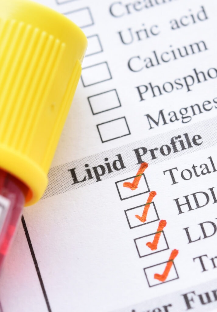 cholesterol lipid profile with LDL and HDL