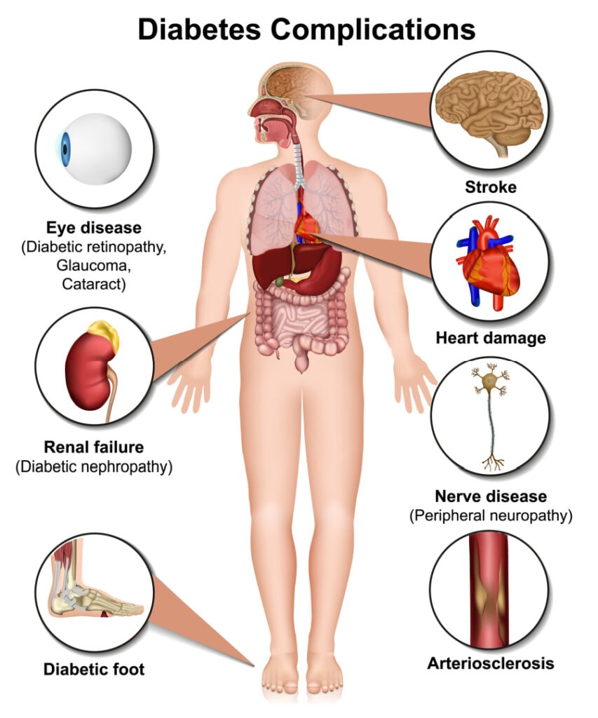 graphic of human body showing complications caused by diabetes